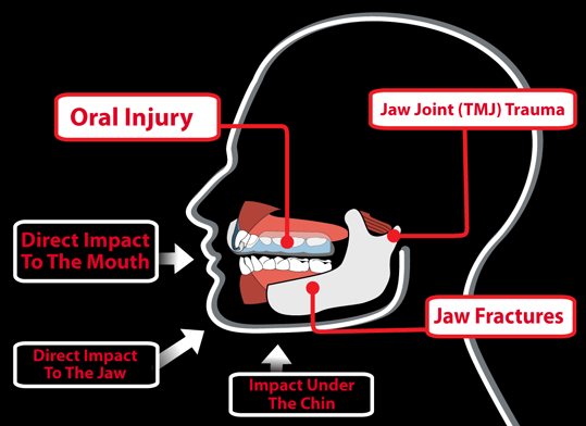 Professional Sports Mouthguard