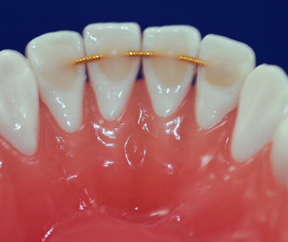 Bonded Retainer How Long Do You Have to Wear Retainers After Braces?