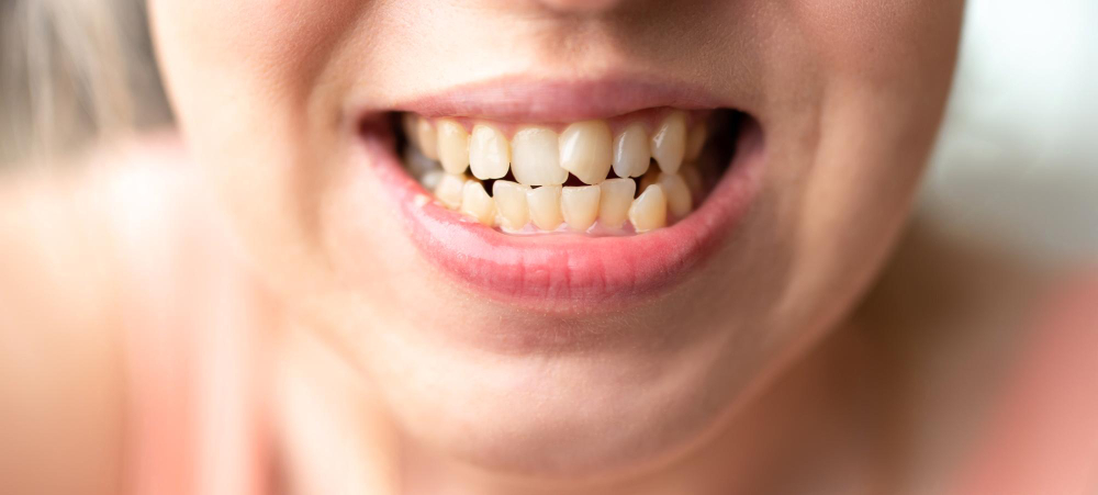 woman's face with crooked teeth