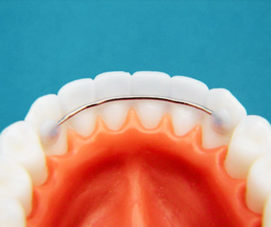 Fixed Retainer How Long Do You Have to Wear Retainers After Braces?