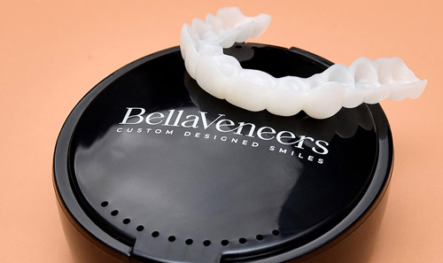 Bellaveneer snap-on veneers