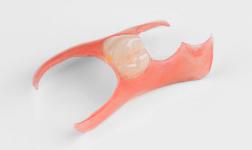 Nesbit Partial denture