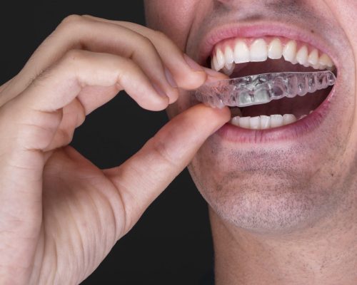 What Safety Does A Professional Sports Mouthguard Provide?