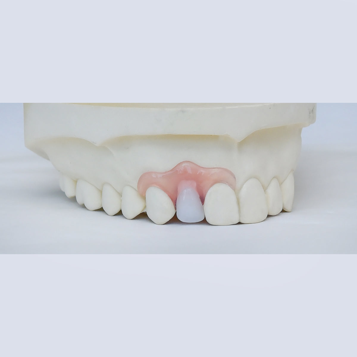 Nesbit (Unilateral) Partial Denture Flipper