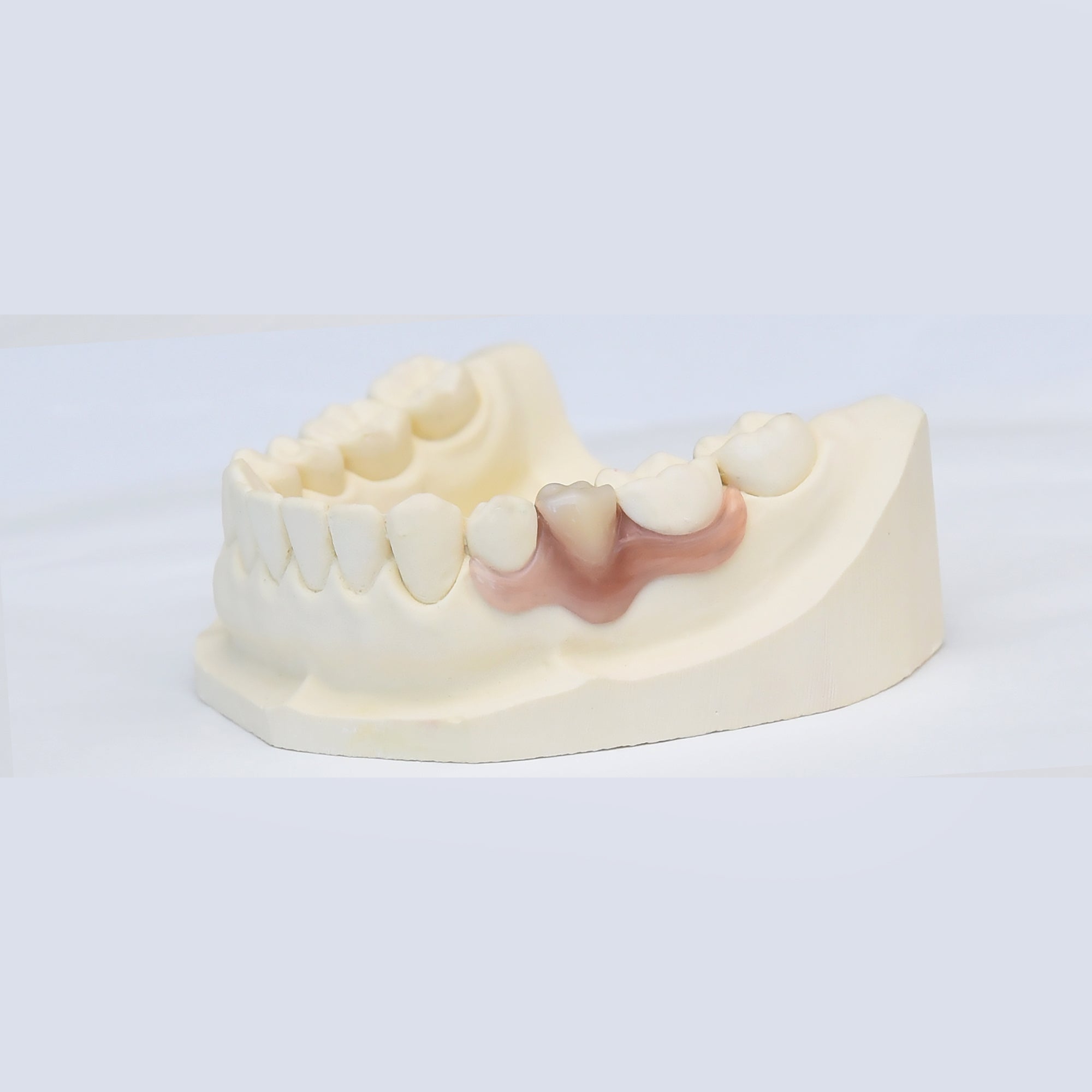 Nesbit (Unilateral) Partial Denture Flipper – Dental Lab Direct