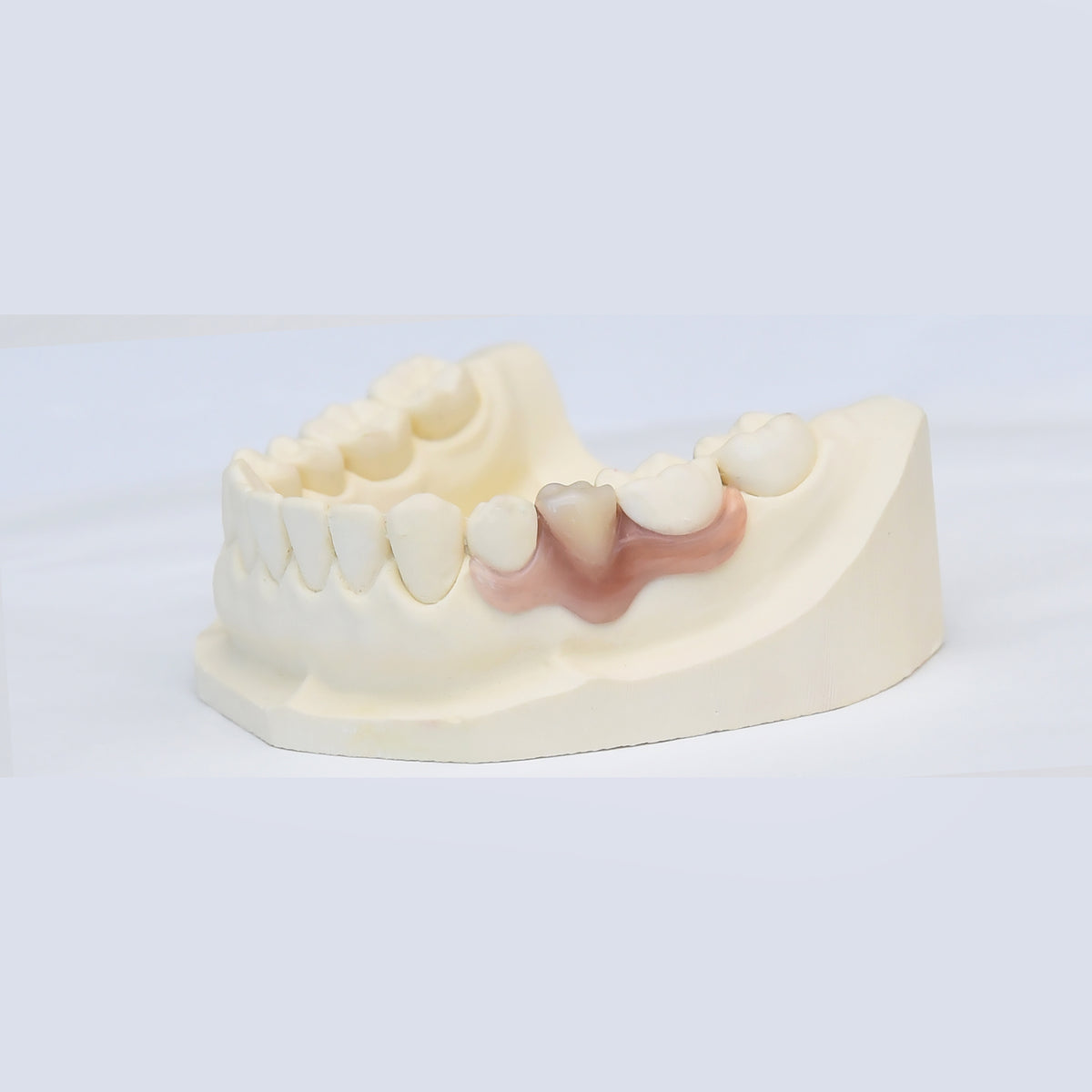 Nesbit (Unilateral) Partial Denture Flipper
