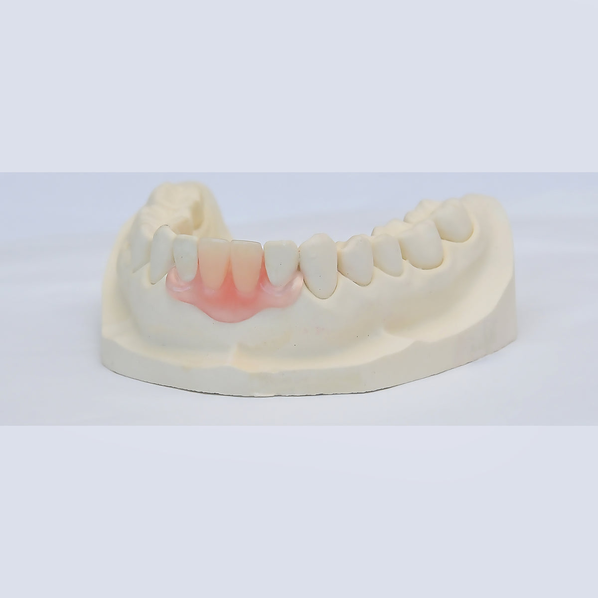 Nesbit (Unilateral) Partial Denture Flipper