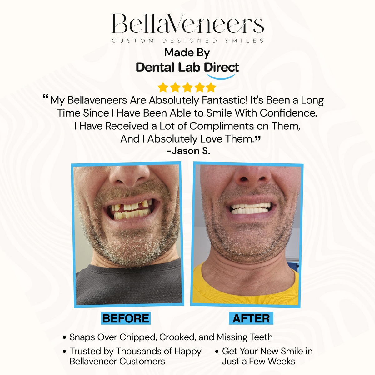 BellaVeneers Custom-Made Snap-On Veneers