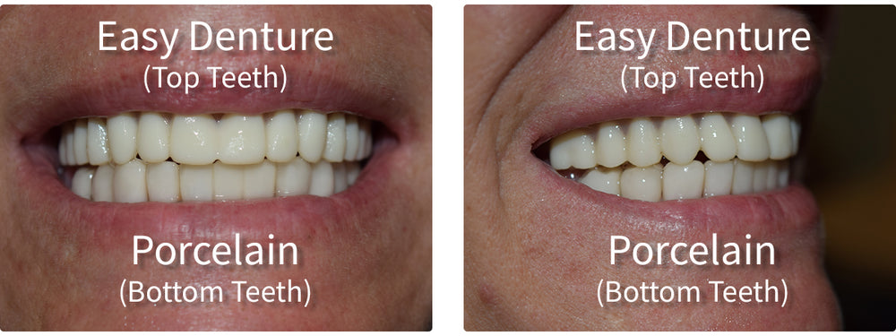 How does Easy Denture compare to porcelain?