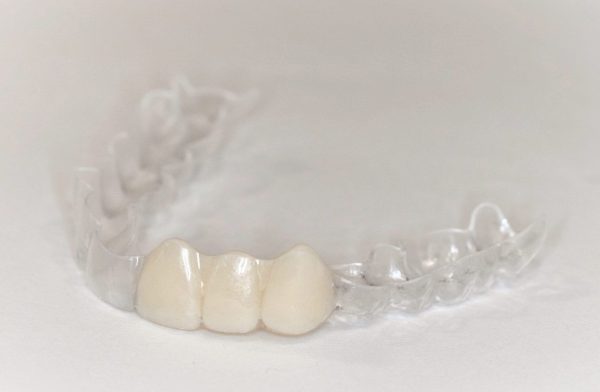 Essix Partial Denture Retainer