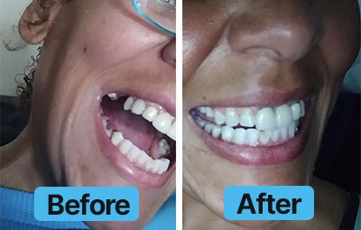Before and after dental treatment comparison showing a person's mouth.