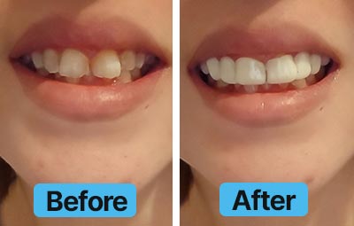 Before and after comparison of teeth with a blue 'Before' and 'After' label.