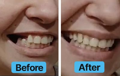 Before and after comparison of teeth with 'Before' on the left and 'After' on the right.