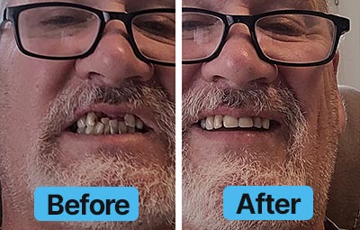 Before and after comparison of a person with glasses showing dental improvement.