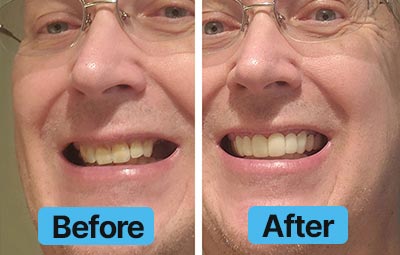 Before and after comparison of a person's smile with dental work.