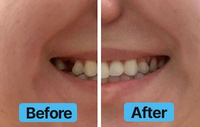 Before and after comparison of teeth with 'Before' on the left and 'After' on the right.
