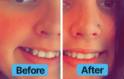Before and after comparison of a person's smile with dental work.