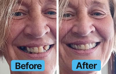 Before and after comparison of a person's smile with 'Before' and 'After' labels.