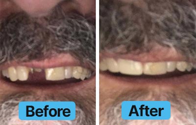 Before and after comparison of teeth with a blue 'Before' and 'After' label.