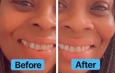 Before and after comparison of a woman's smile with 'Before' on the left and 'After' on the right.