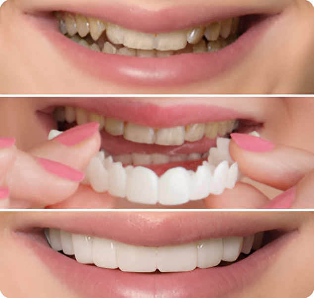 BellaVeneers Custom-Made Snap-On Veneers