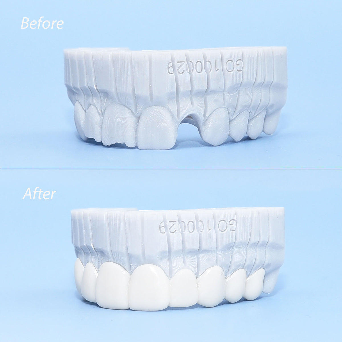 BellaVeneers Custom-Made Snap-On Veneers