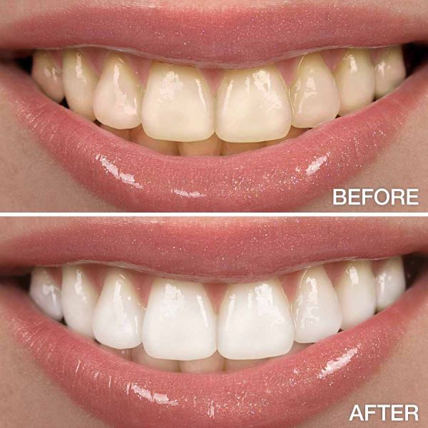 DLD Professional Teeth Whitening Kit