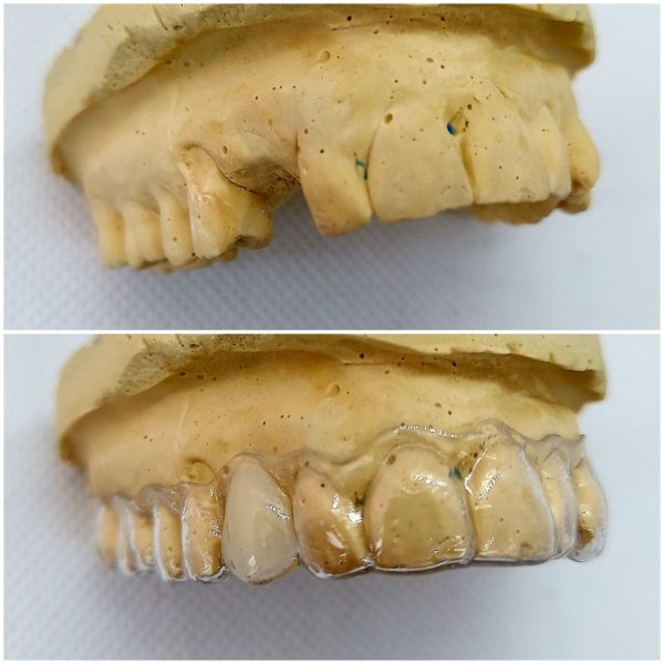 Essix Partial Denture Retainer