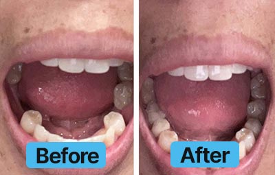 What Is A Valplast Partial Denture Dental Lab Direct What Is A Valplast Partial Denture Dental Lab Direct