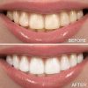 bleached teeth DLD Professional Teeth Whitening Kit