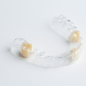 A photo of an Essix partial denture retainer