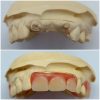 flwxi before after scaled Flexible Partial Denture