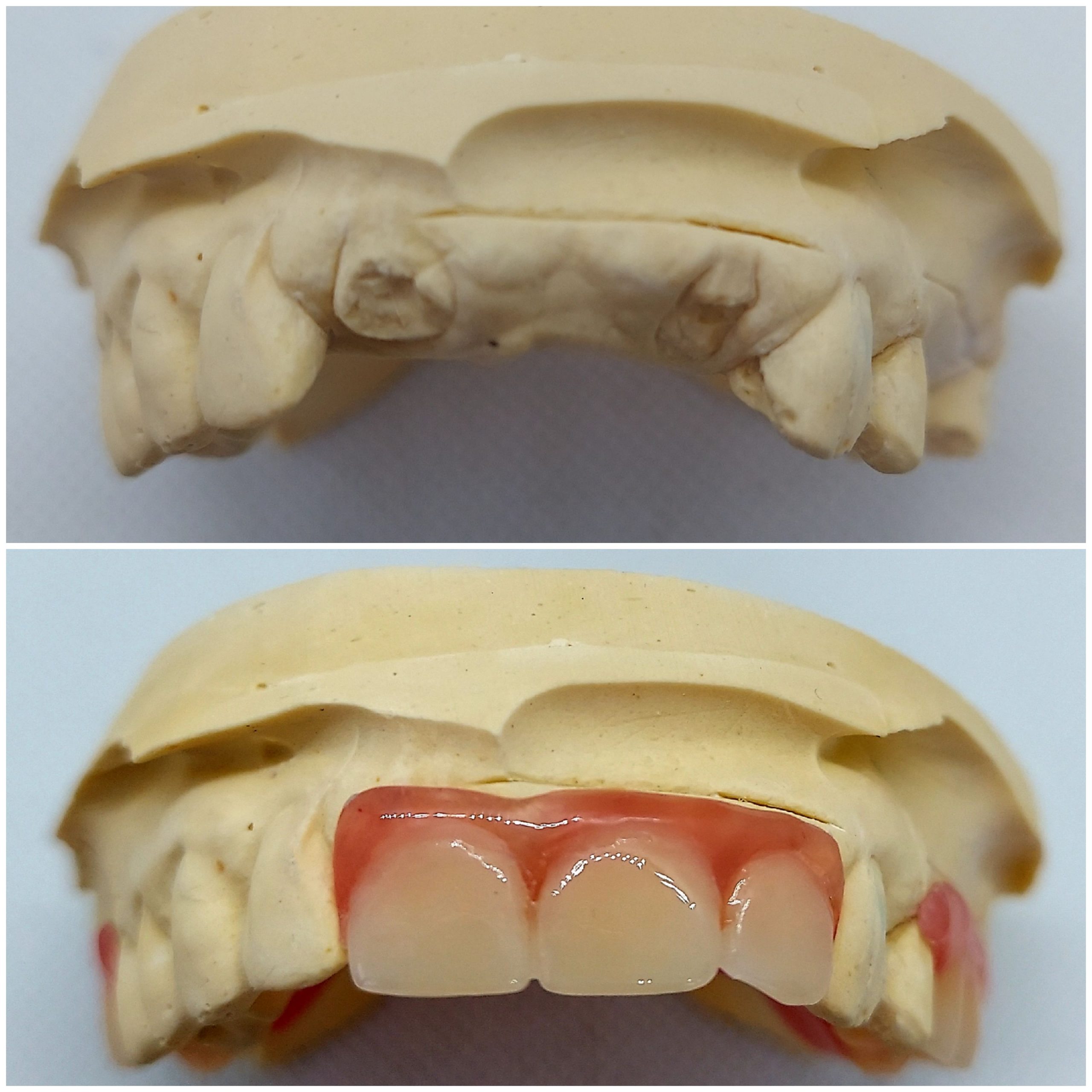 what are flexible partial dentures made of