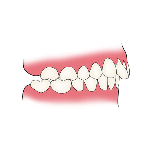 partial 1 Nesbit Flexible Partial Denture