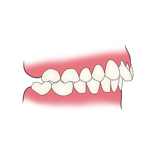 partial 1 Essix Partial Denture Retainer