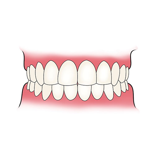 partial 2 Acrylic Partial Denture Flipper