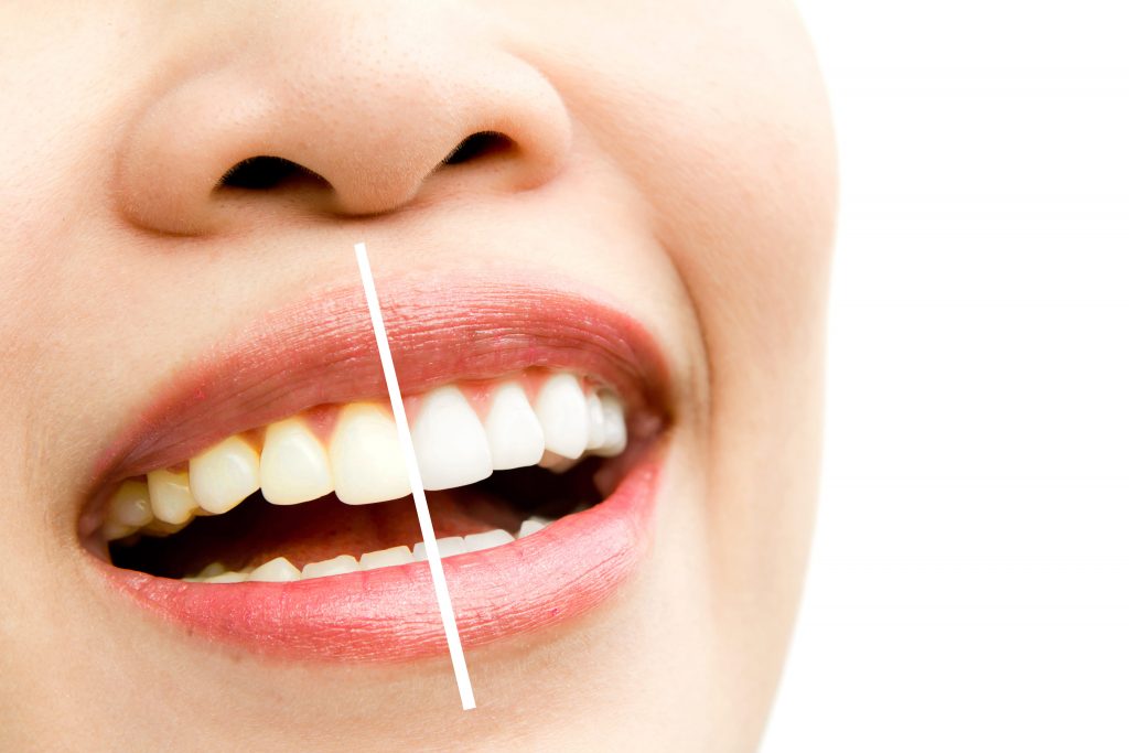 The lady's teeth show the difference of teeth whitening