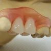 nesbit 2 teeth on model scaled Nesbit Flexible Partial Denture