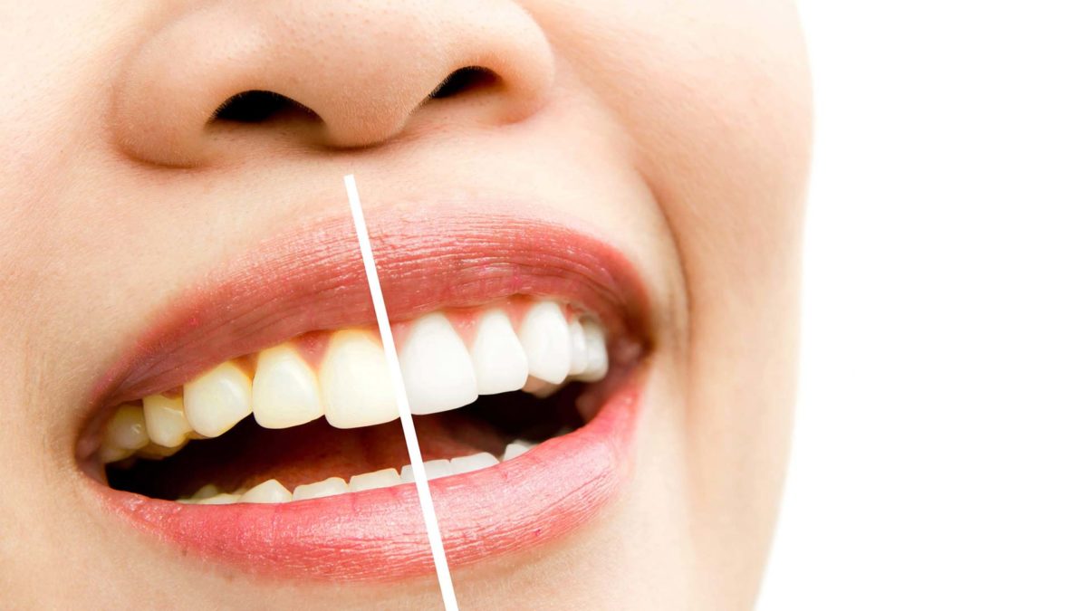 The lady's teeth show the difference of teeth whitening