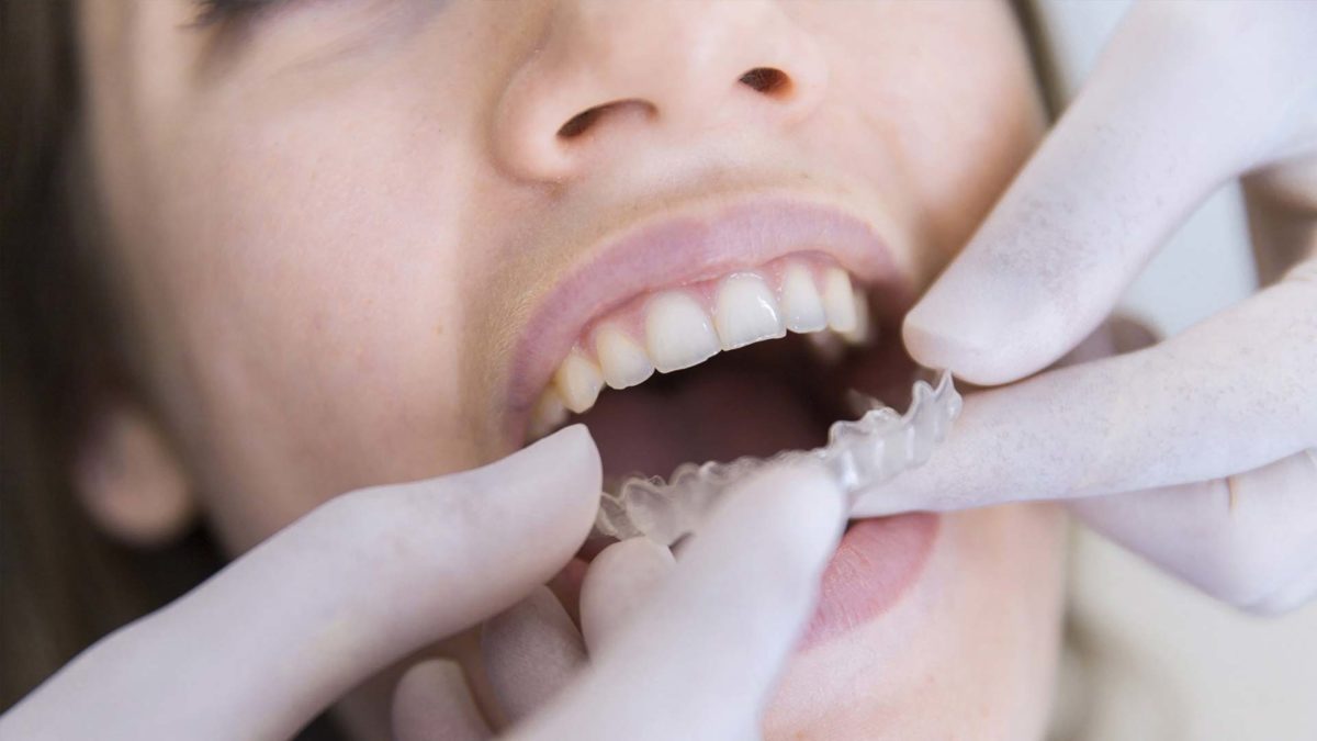 Dentist fixing nightguard to patient