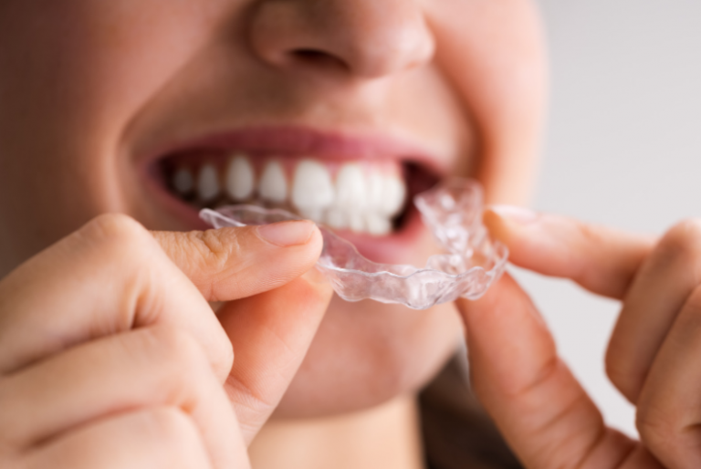5 Ways a Mouth Guard for Clenching Can Help Dental Lab Direct
