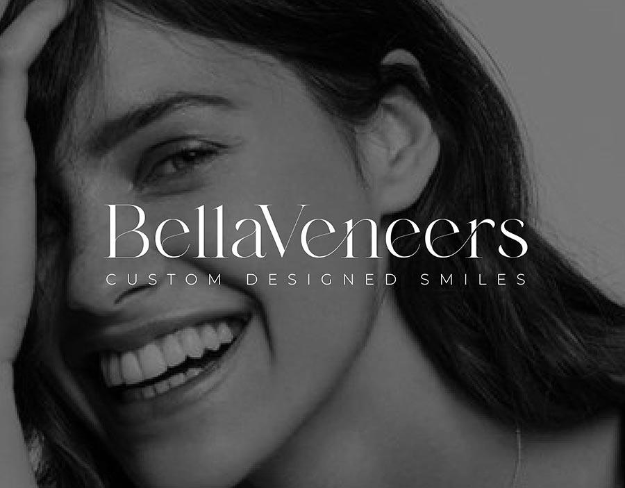 bella 1 BellaVeneers Custom-Made Snap-On Veneers (Premium)
