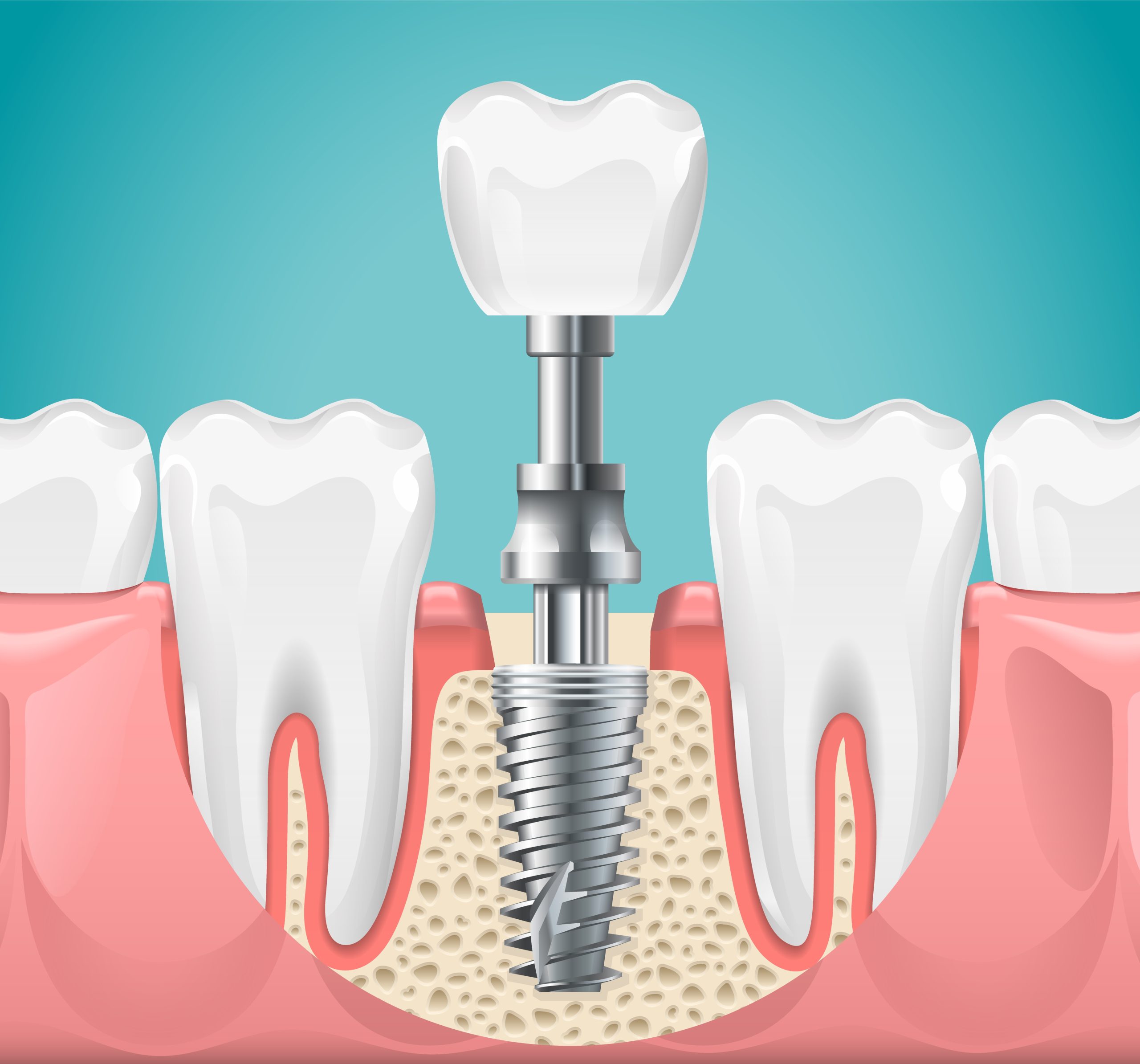Dental Implant Procedure dental surgery. tooth implant cut illustration, healthy teeth and dental implant