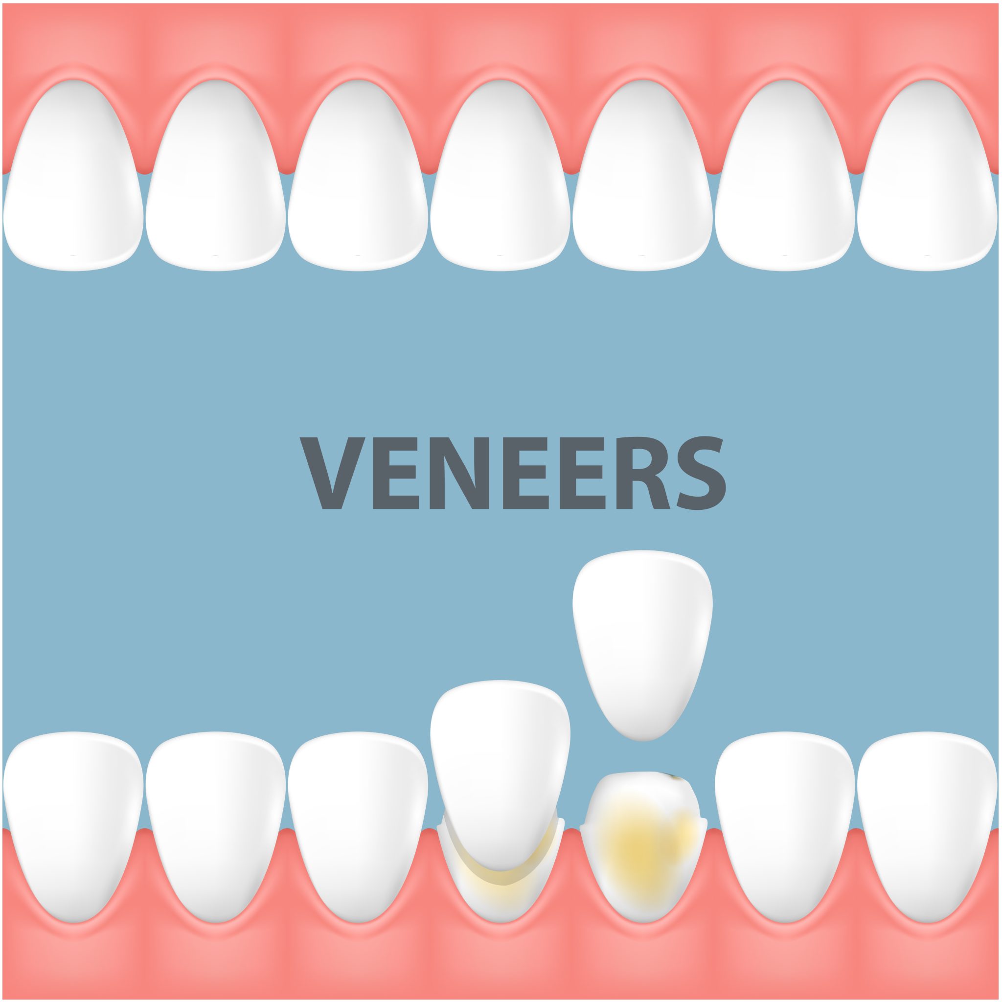 What Is The Best Type Of Veneers For Your Teeth? - Dental Lab Direct