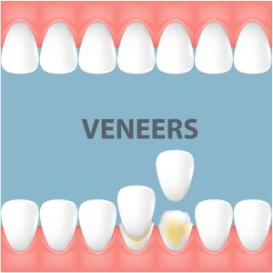 Dental Veneers: What They Are and How They Work 