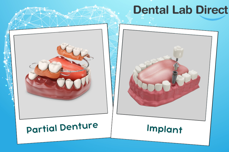 Partial Denture vs. Implant – Which One is Right for You? - Dental Lab ...