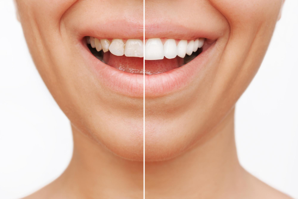 Benefits of Getting Veneers