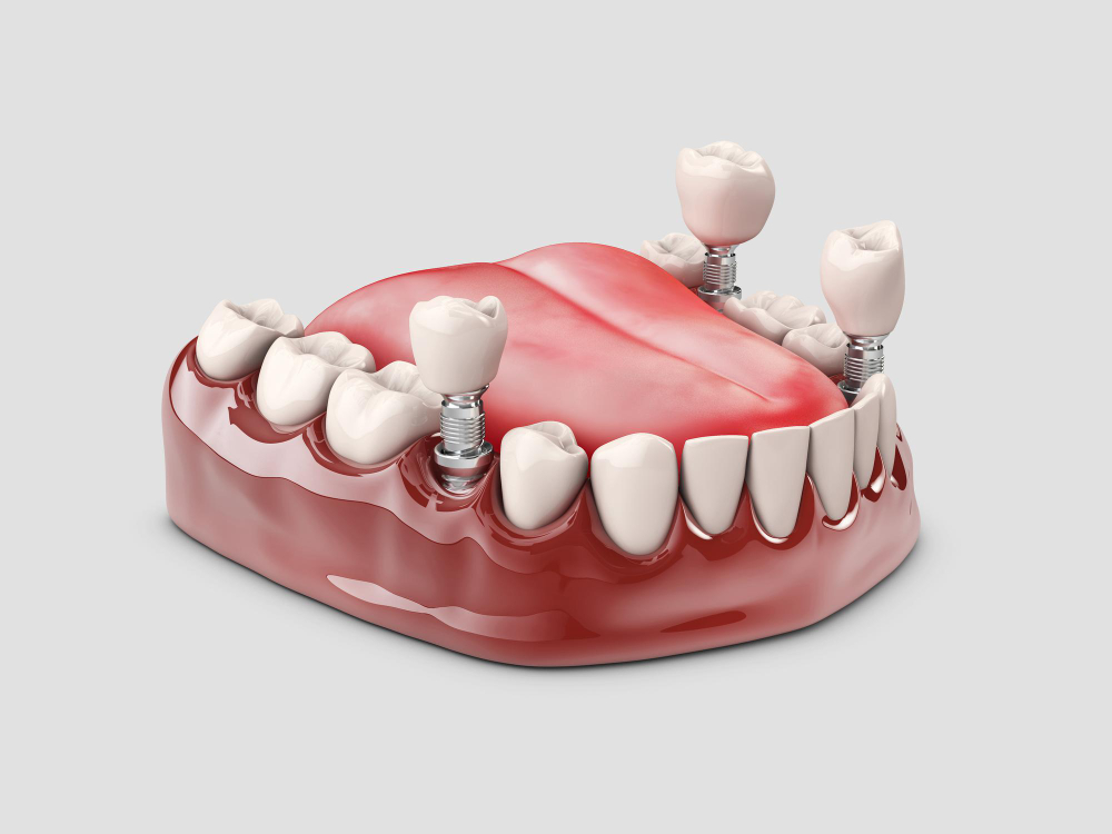 Photo human teeth and dental implant. 3d illustration.