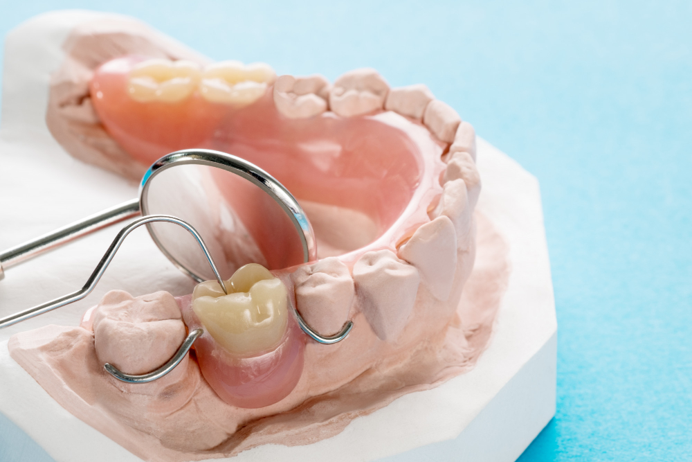 Front tooth partial dentures with metal clasps