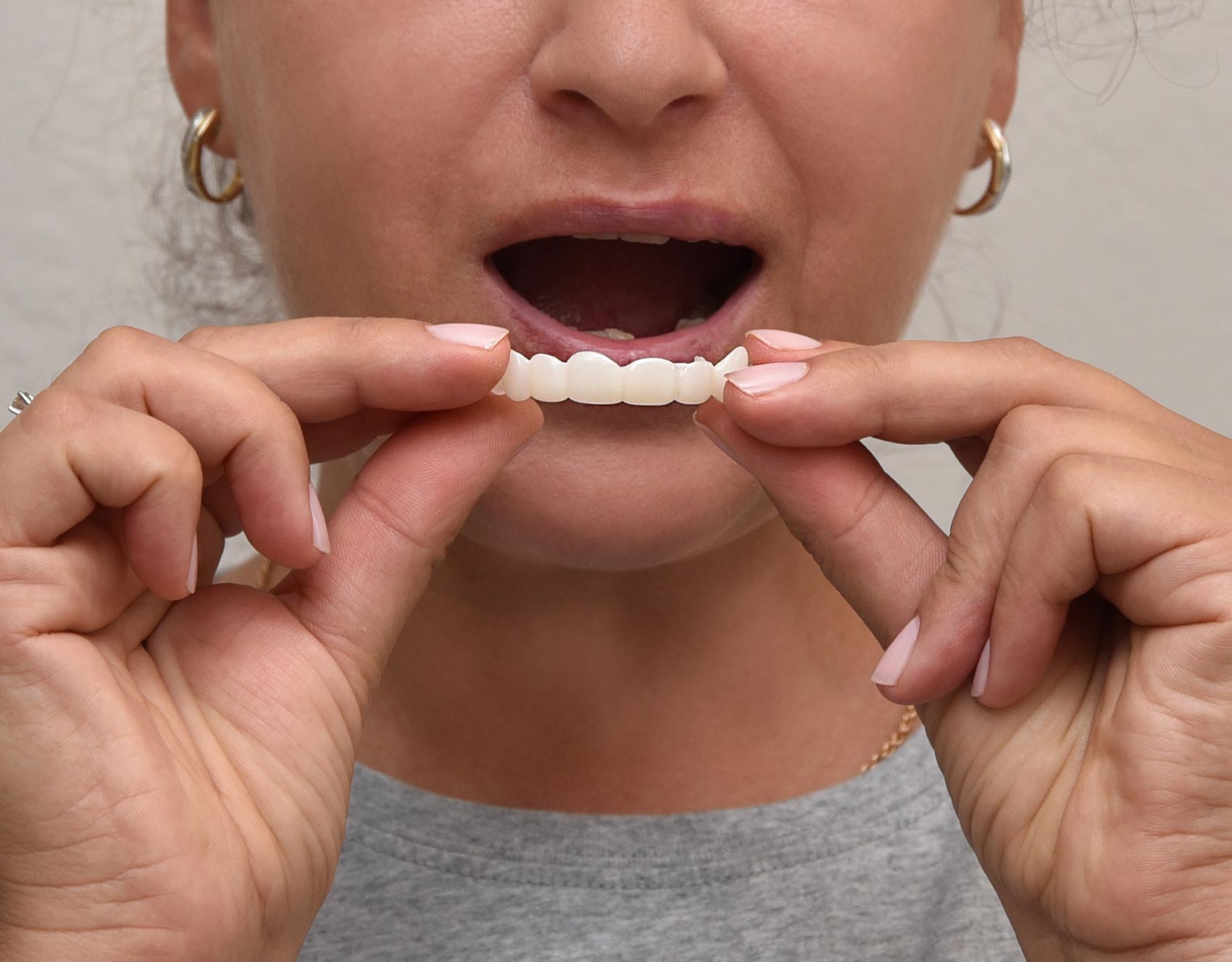 Everything You Need To Know About Snap-On Veneers